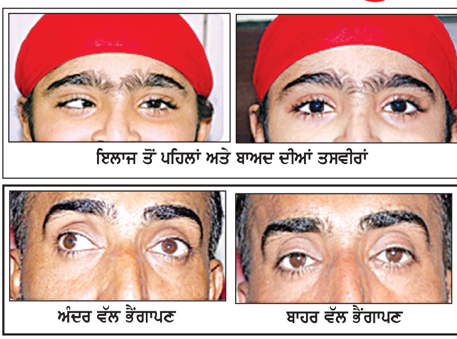 ਅੱਖਾਂ ਦਾ ਭੈਂਗਾਪਣ : ਸਮੇਂ ਸਿਰ ਪਛਾਣ ਅਤੇ ਇਲਾਜ ਜ਼ਰੂਰੀ